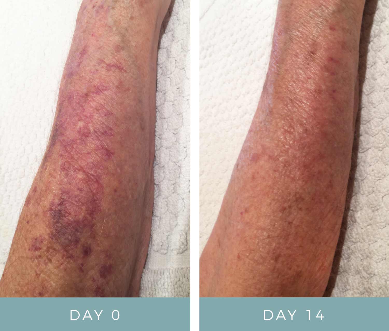 Before and After - Actinic Purpura