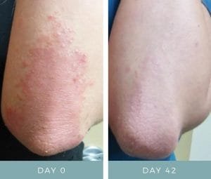 Before and After - Psoriasis