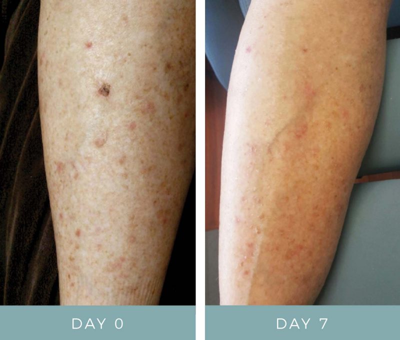 before-after-chemotherapy-rash-1-neogenesis