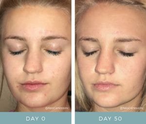 Before & After - Acne