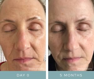 Before + After - Aging Skin