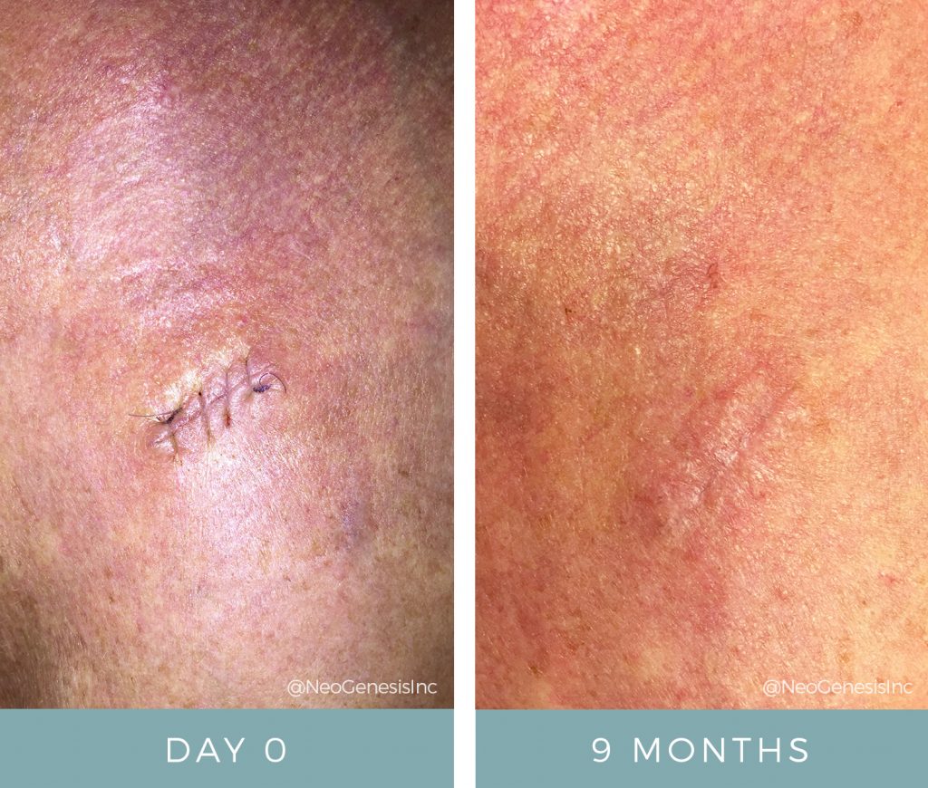 Before After Basal Cell Carcinoma Neogenesis 3803