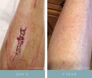 Before + Afters - Post Cancer Surgery Scar Reduction