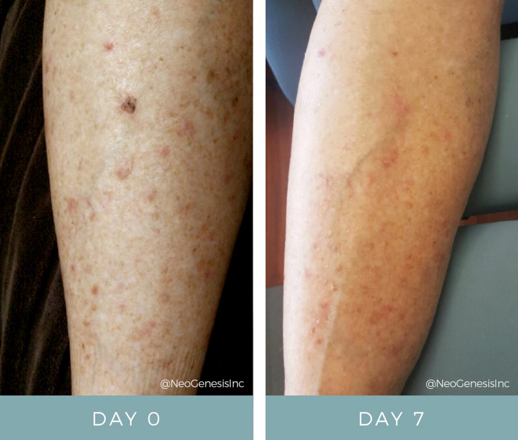 Before After Chemotherapy Rash 1 Neogenesis 