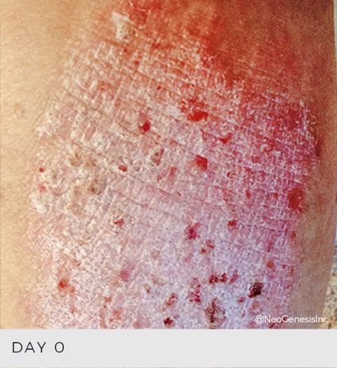 Before + After - Dermatitis 1 - NeoGenesis