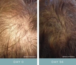 Hair Loss + NeoGenesis Hair Thickening Serum