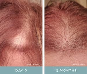 Before & After - Hair Loss Products for Women