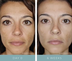 Before + After - Hyperpigmentation