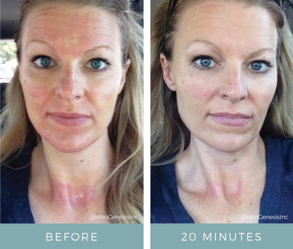 Microneedling Neogenesis Products Before After 4410