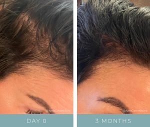 Before + After - Hair Loss Treatment for Women