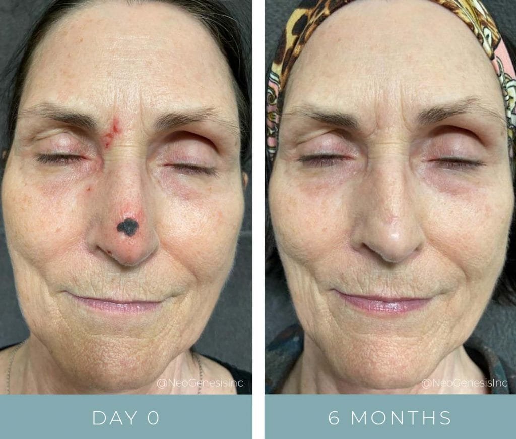 Before + After - Lesion