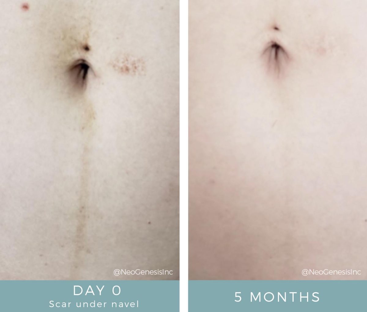 before-after-post-pregnancy-scar-reduction-neogenesis