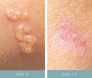 Before + After - Shingles