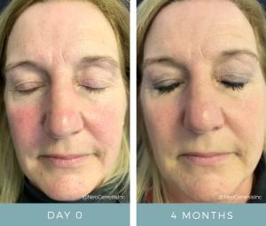 Before + After - Rosacea + Aging Skin