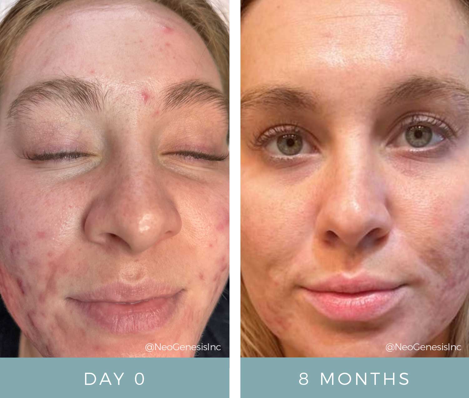 Before After Acne NeoGenesis