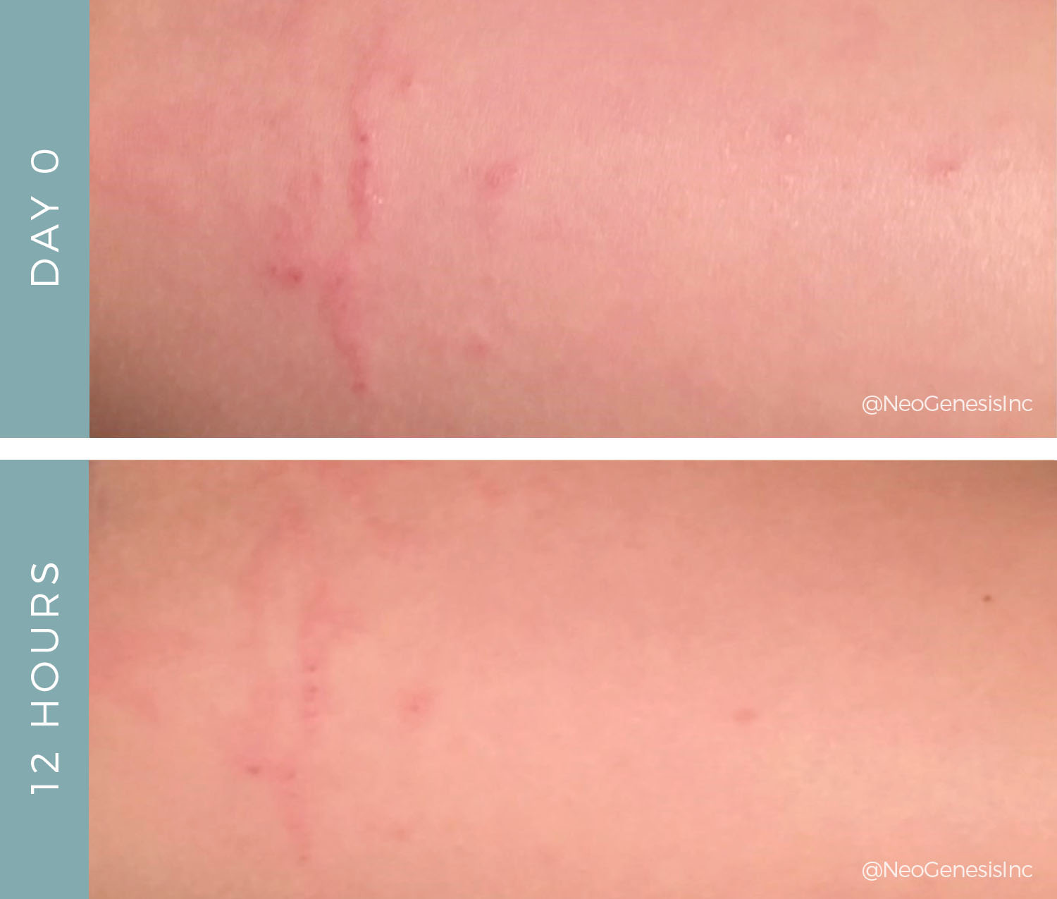 Before After Allergic Reaction Eczema Neogenesis