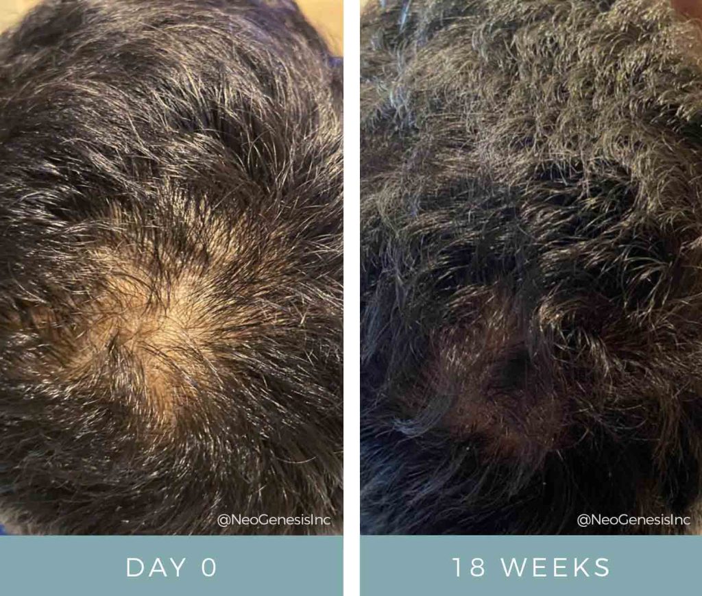 Hair Loss + Microneedling