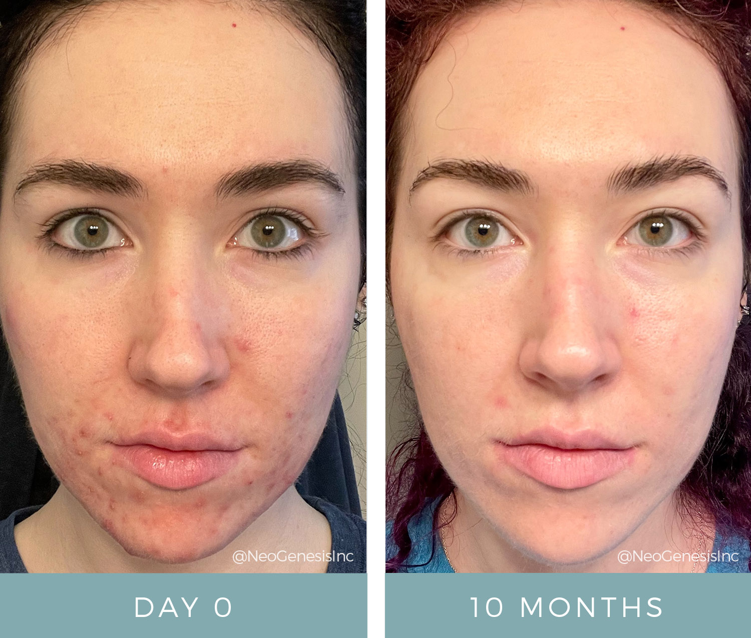 Before After Hormonal Acne NeoGenesis Products Acneic Skin