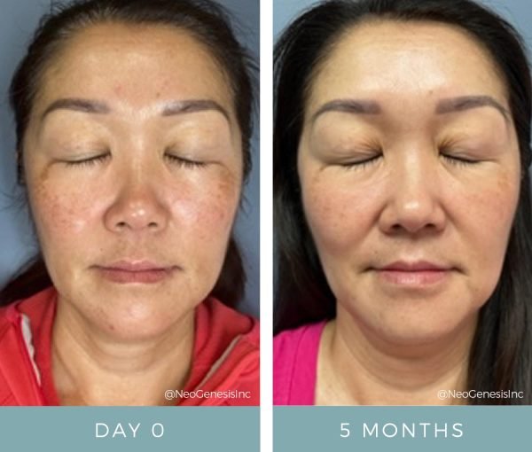 Before + After Melasma Sun Damage PIH NeoGenesis Case Study