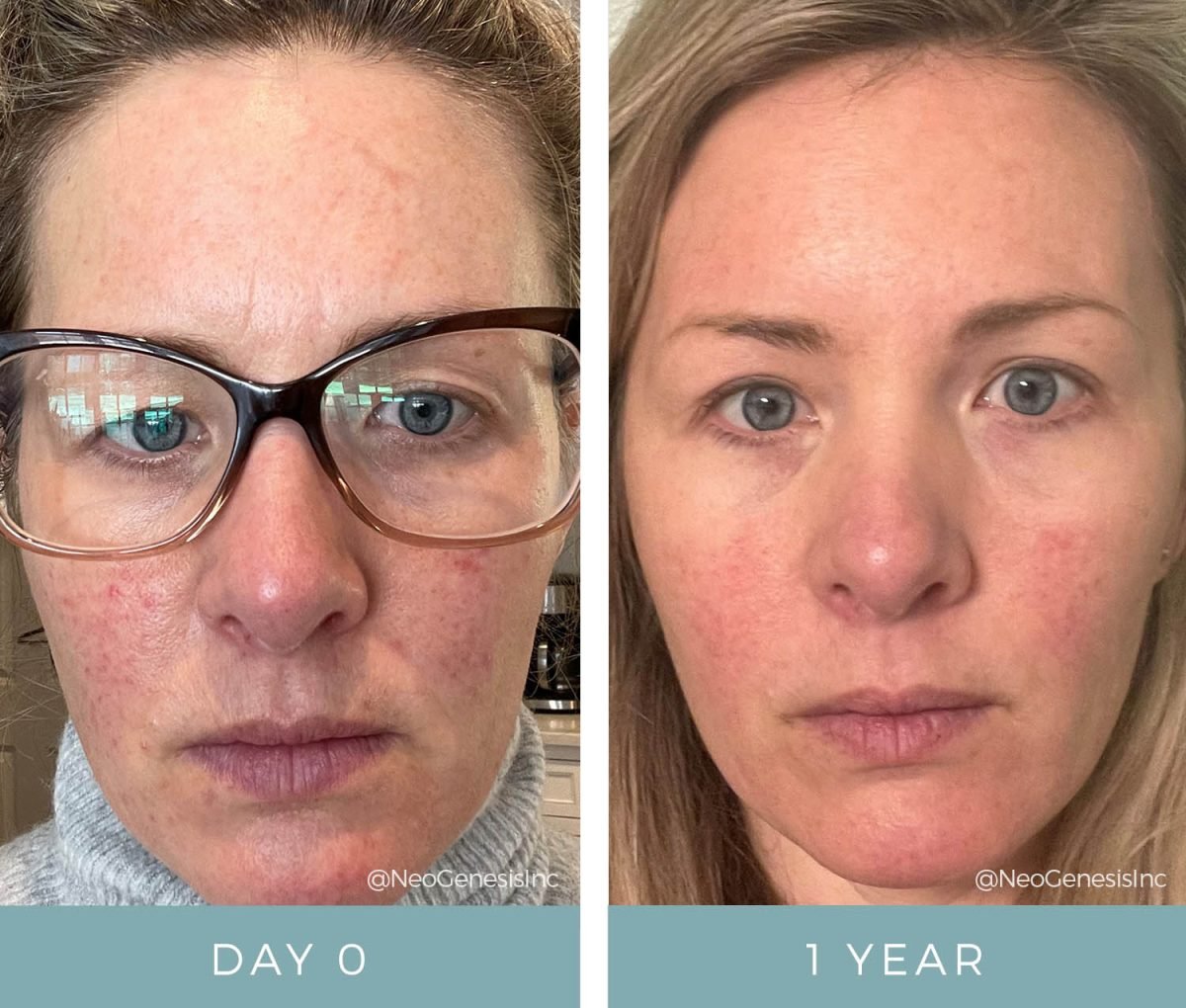 Before After Rosacea 4 Neogenesis