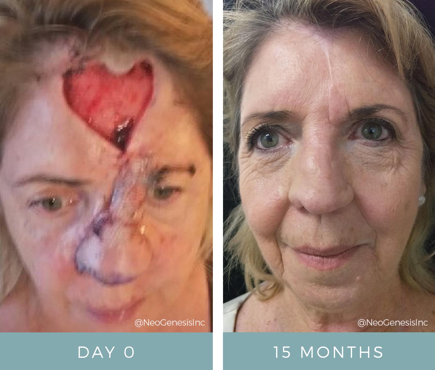 Before + After - Basal Cell Carcinoma - Cancer Surgery