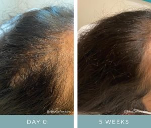 Before + After - Hair Loss + Microneedling