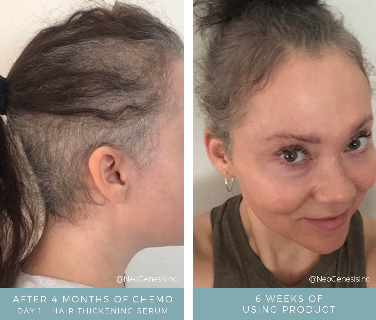 Before After Chemo Hair Lash Brow Loss NeoGenesis