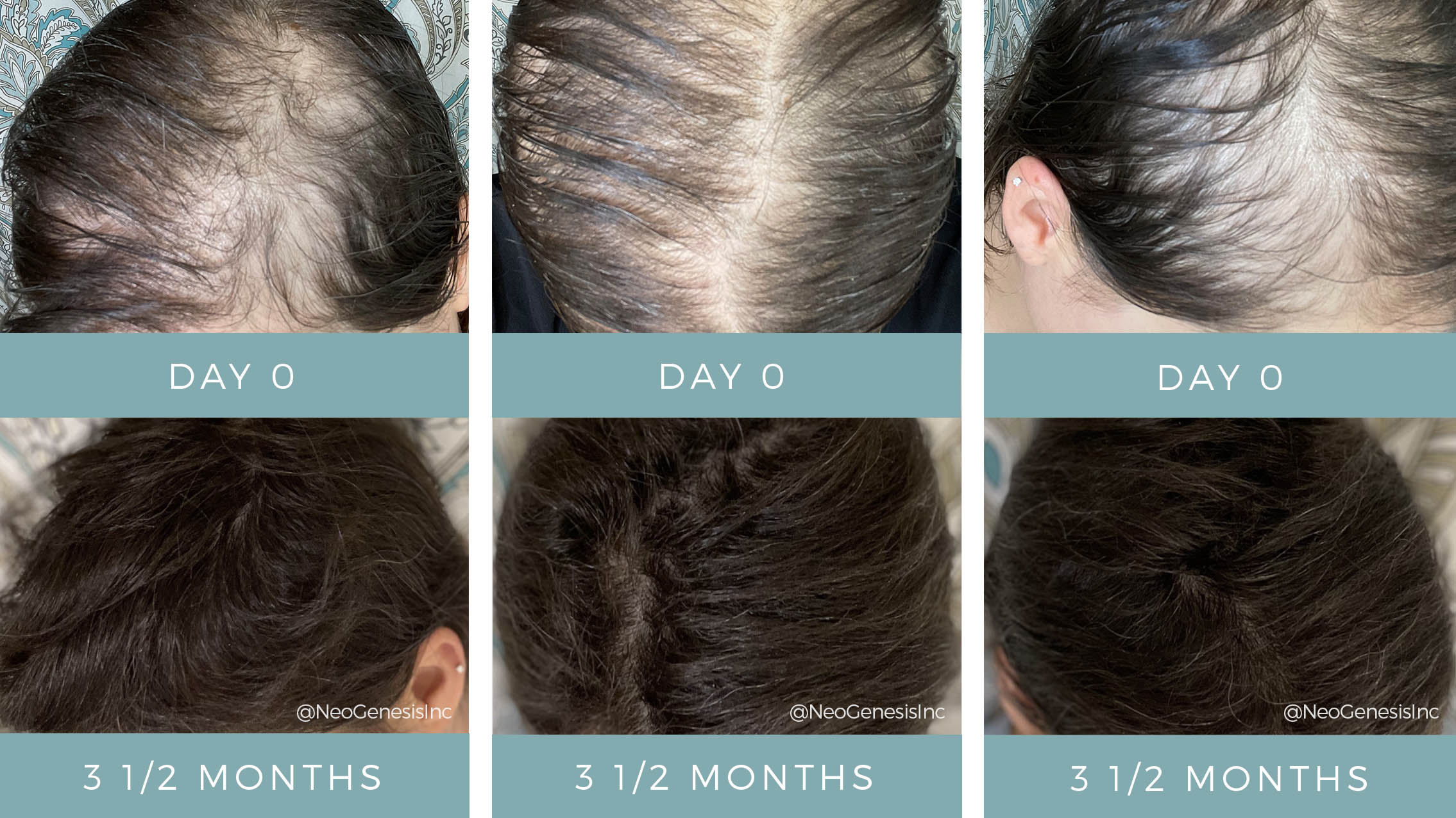 Before After Chemo Hair Loss NeoGenesis