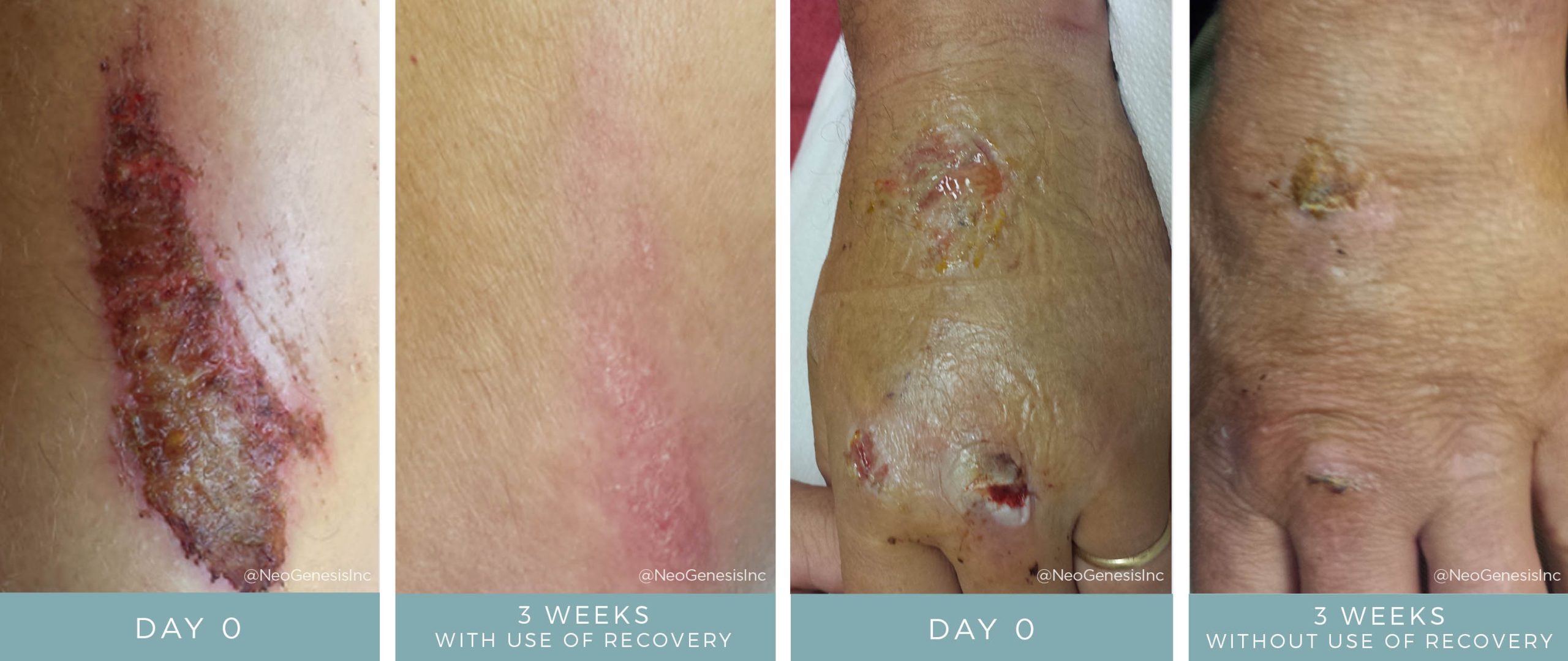 Before + After - Wound Care - Mountain Biking Accident