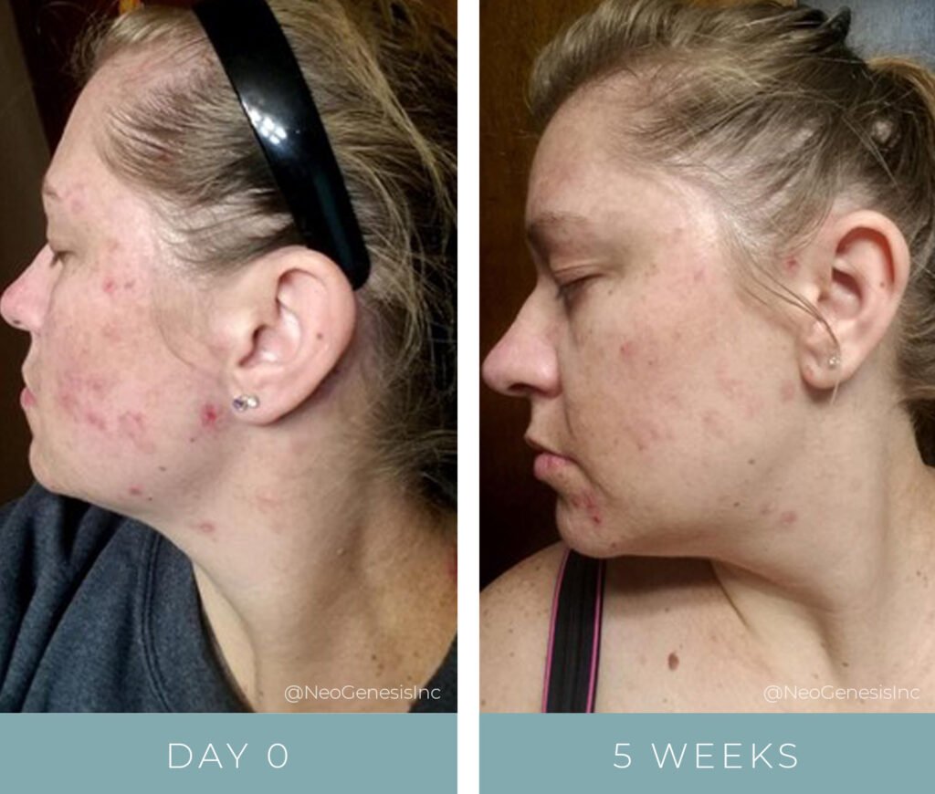 Before + After - Acne