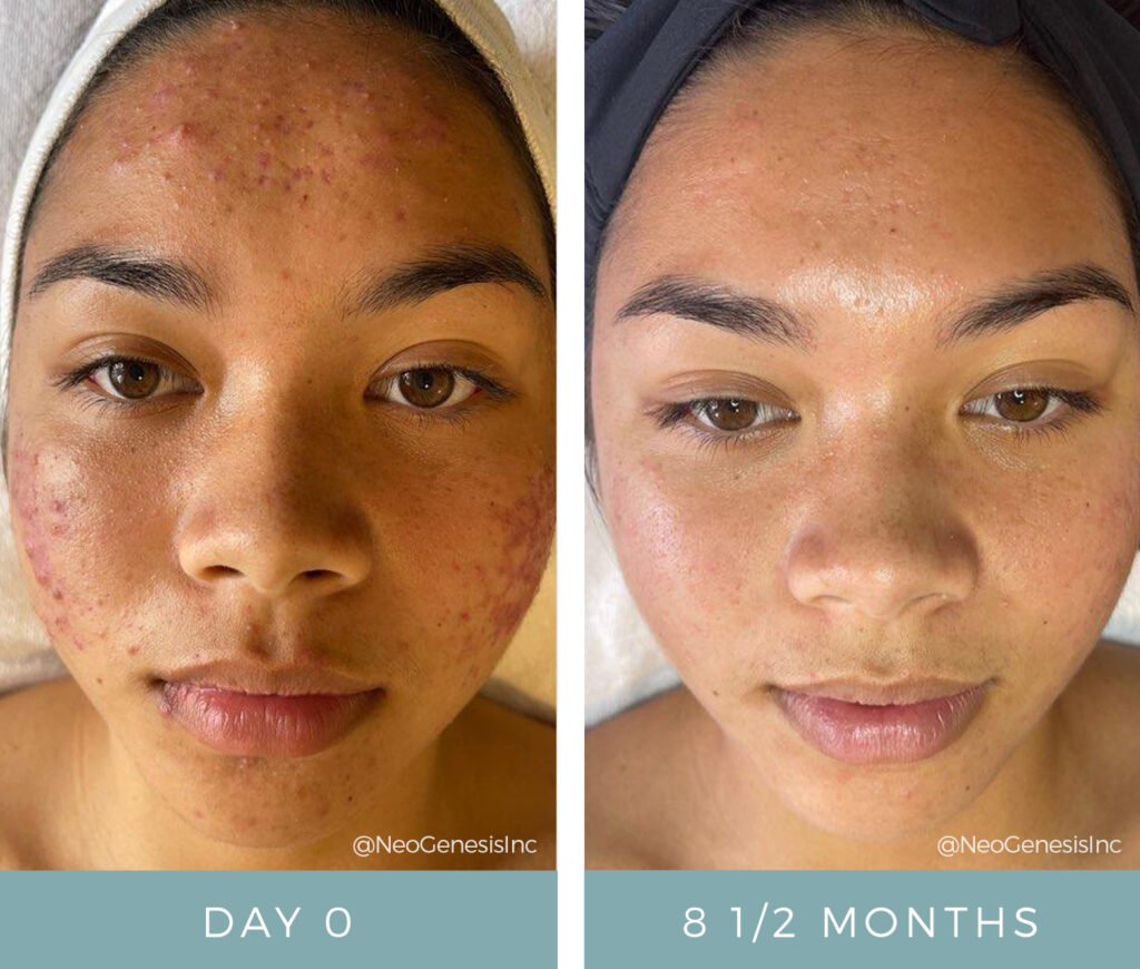 Before + After - Acne