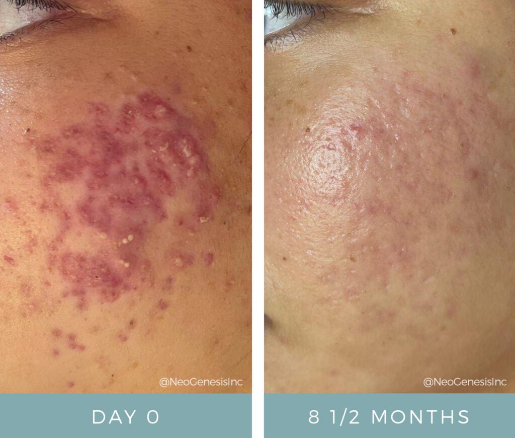 Before + After - Acne