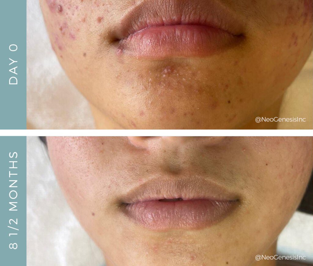 Before + After - Acne