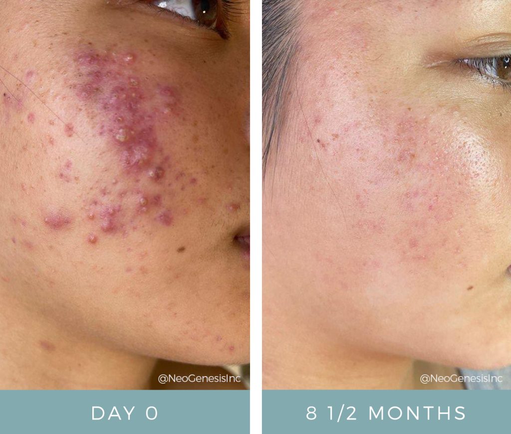 Before + After - Acne