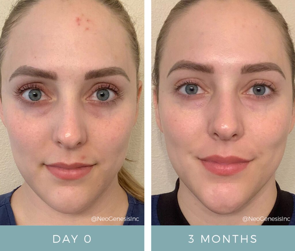 Before + After - Acne