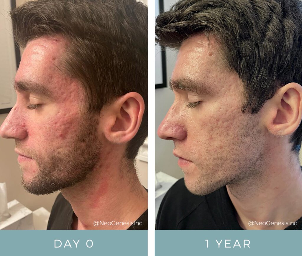 Before + After - Acne