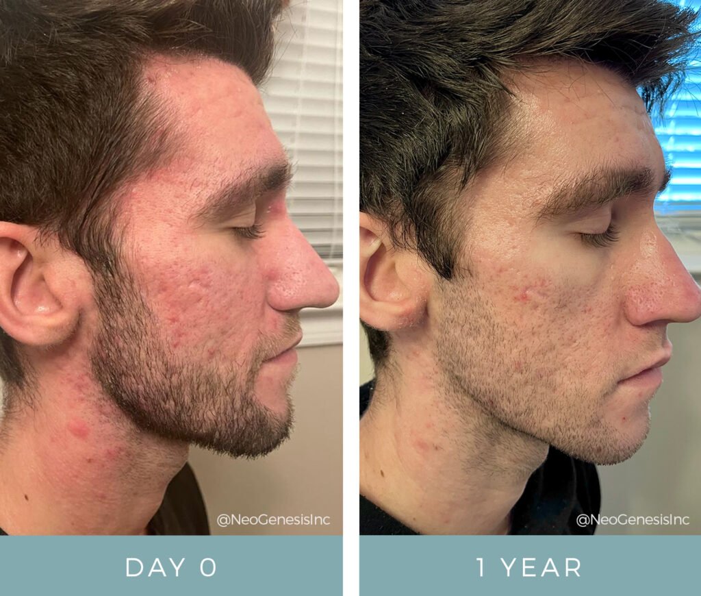 Before + After - Acne