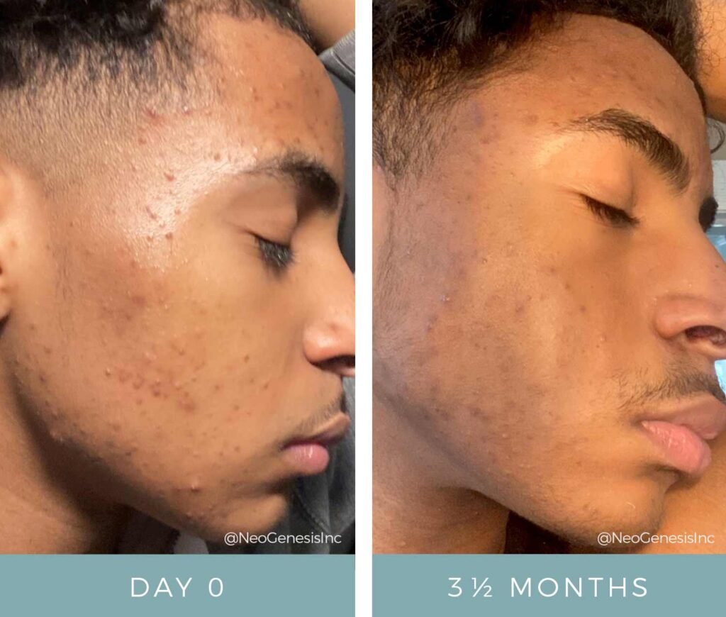 Before + After - Acne