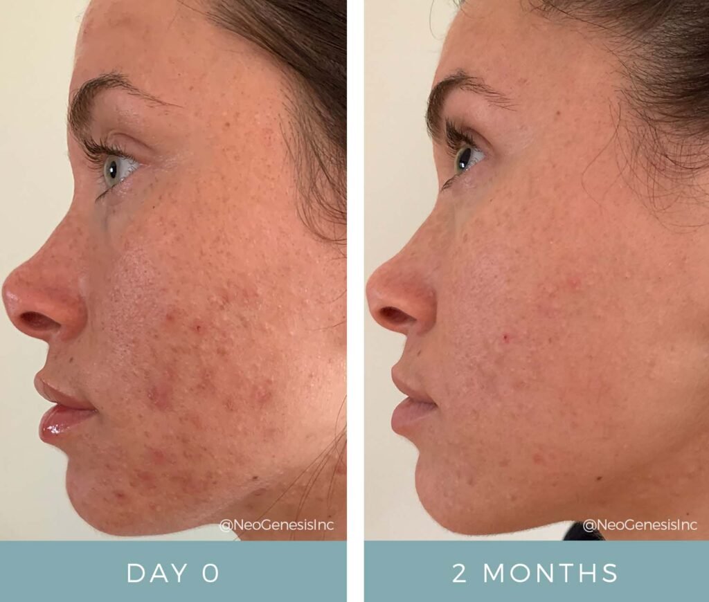 Before + After - Acne