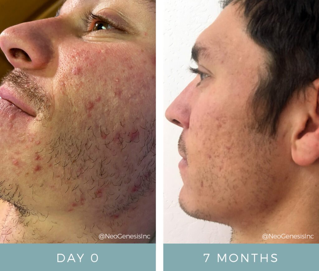 Before + After - Acne