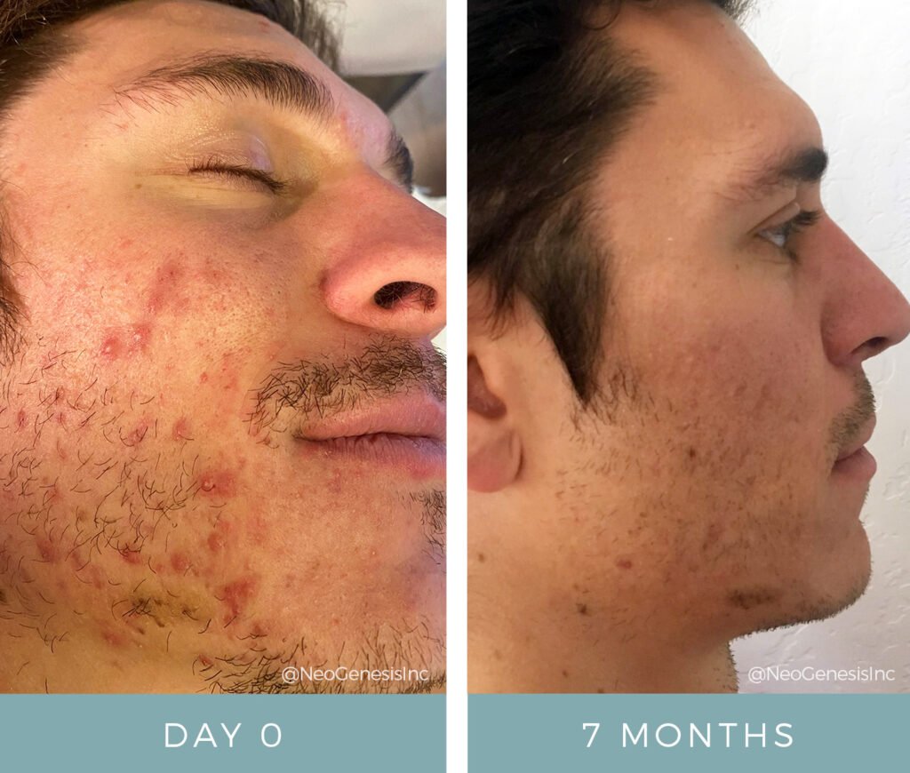 Before + After - Acne