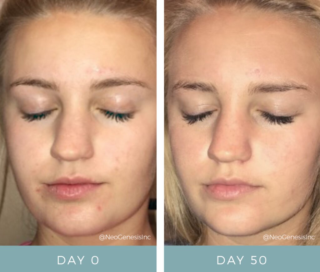 Before + After - Acne