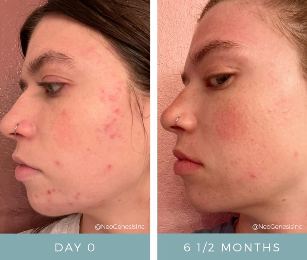 Before + After - Acne + Sensitive Skin