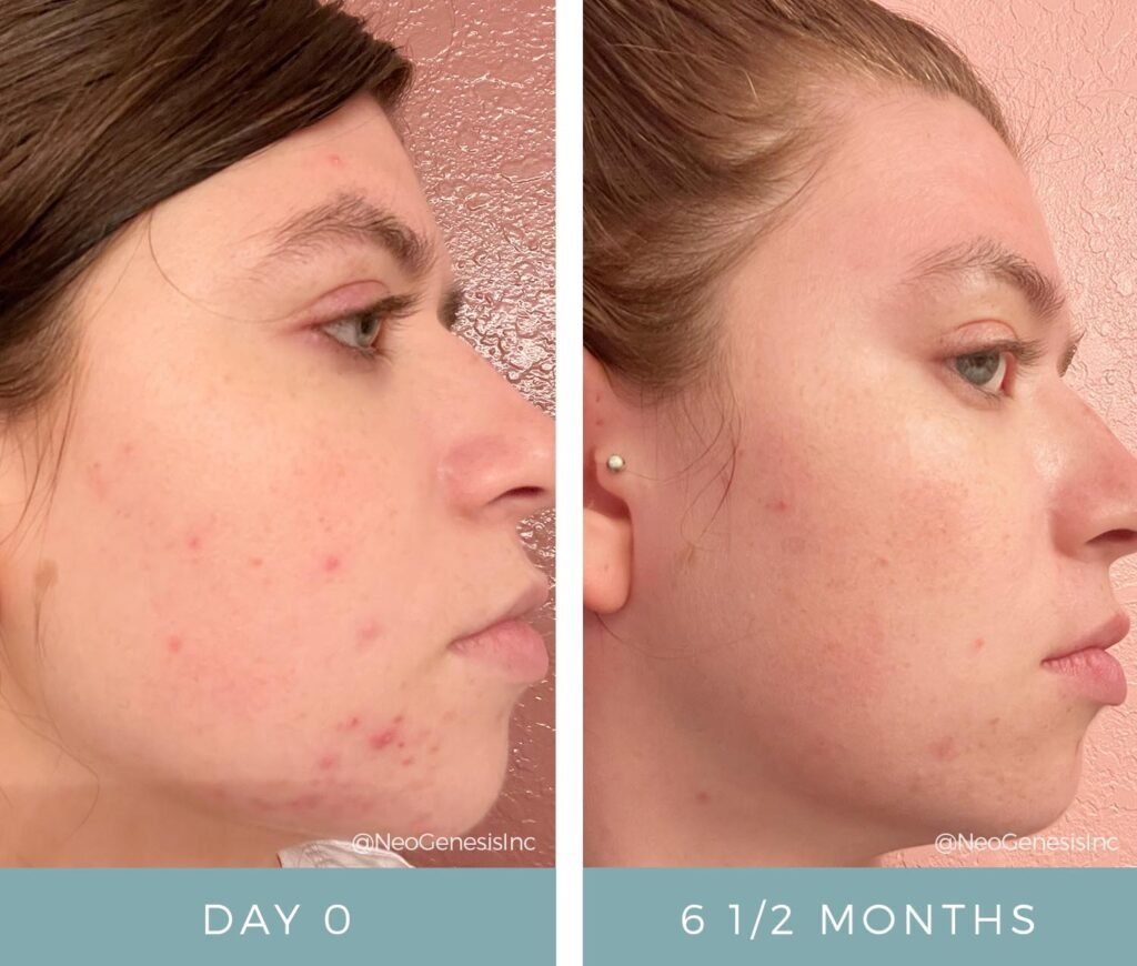 Before + After - Acne + Sensitive Skin