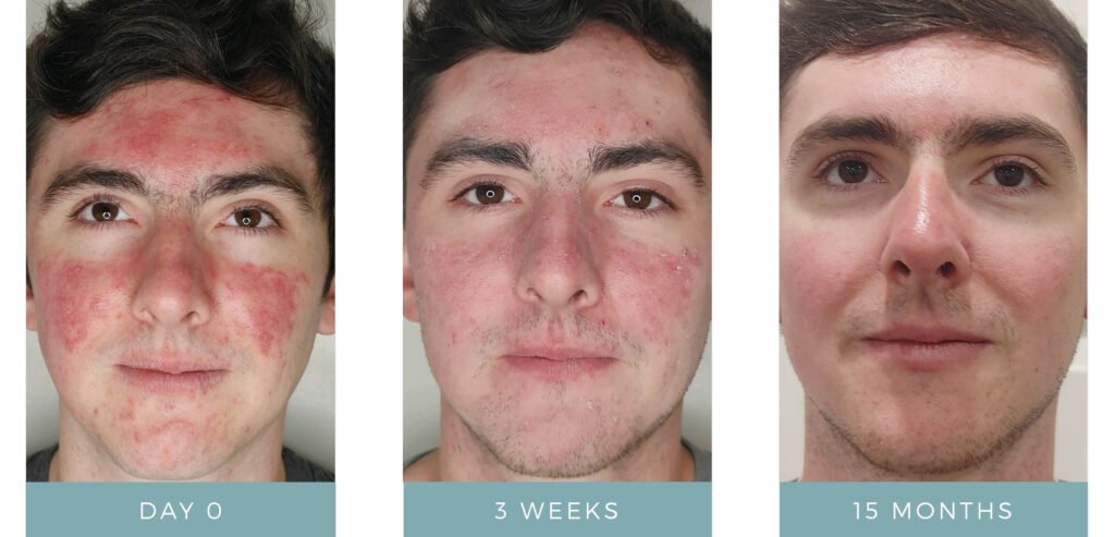 Before + After - Acne + Contact Dermatitis