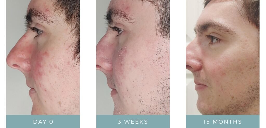 Before + After - Acne + Contact Dermatitis