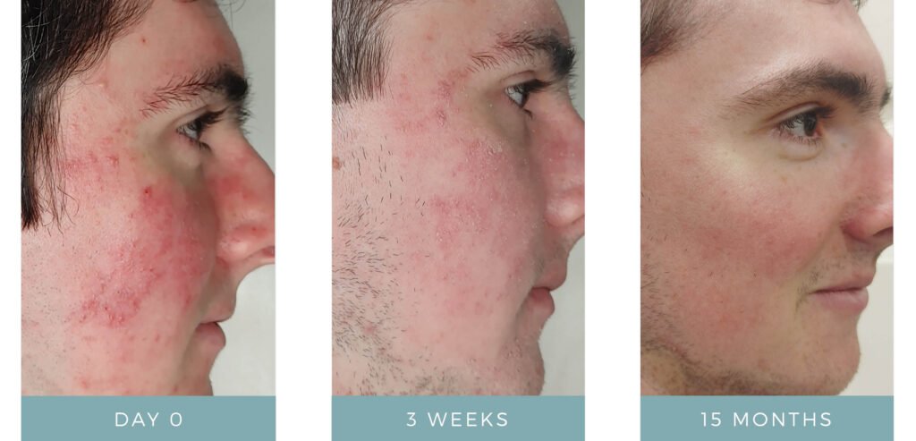 Before + After - Acne + Contact Dermatitis