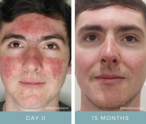 Acne + Contact Dermatitis - Before + After