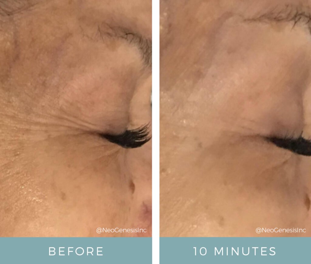 Before + After - Aging Skin - Crows Feet