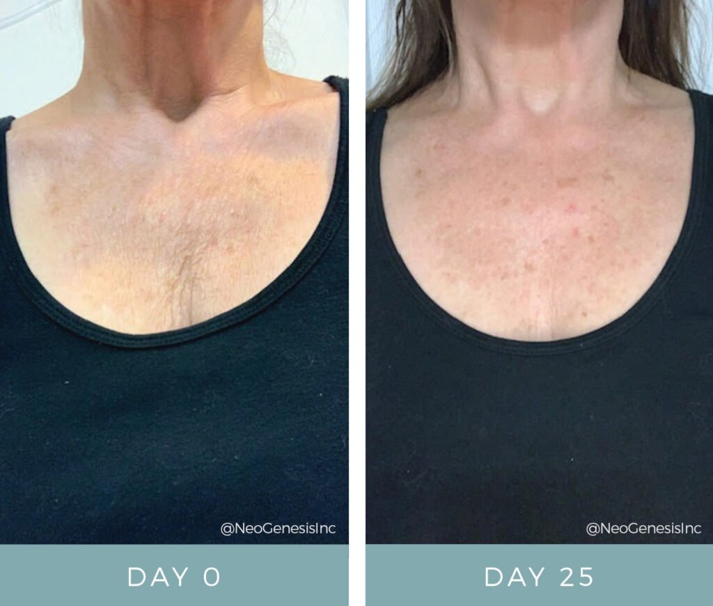 Before + After - Aging Skin - Decolette